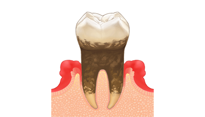中等度歯周病